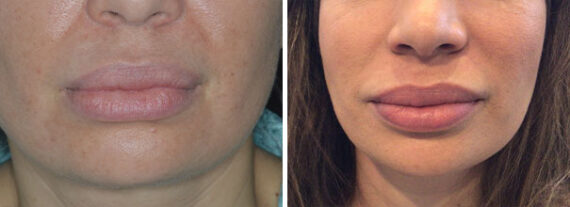 Lip Reduction Before and After Photos in Miami, FL, Patient 9050