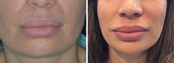 Lip Reduction Before and After Photos in Miami, FL, Patient 9050