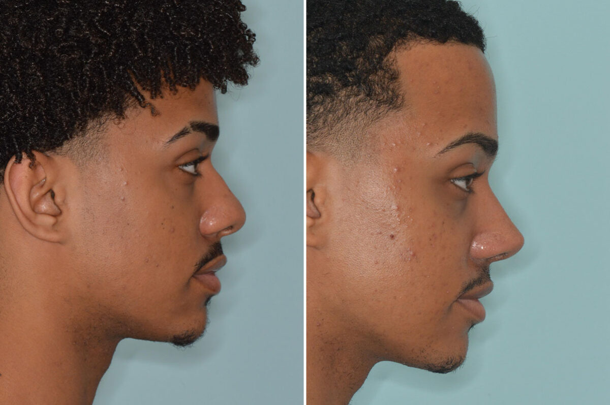 Ethnic Rhinoplasty Before and After Photos in Miami, FL, Patient 9057