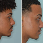 Ethnic Rhinoplasty Before and After Photos in Miami, FL, Patient 9057