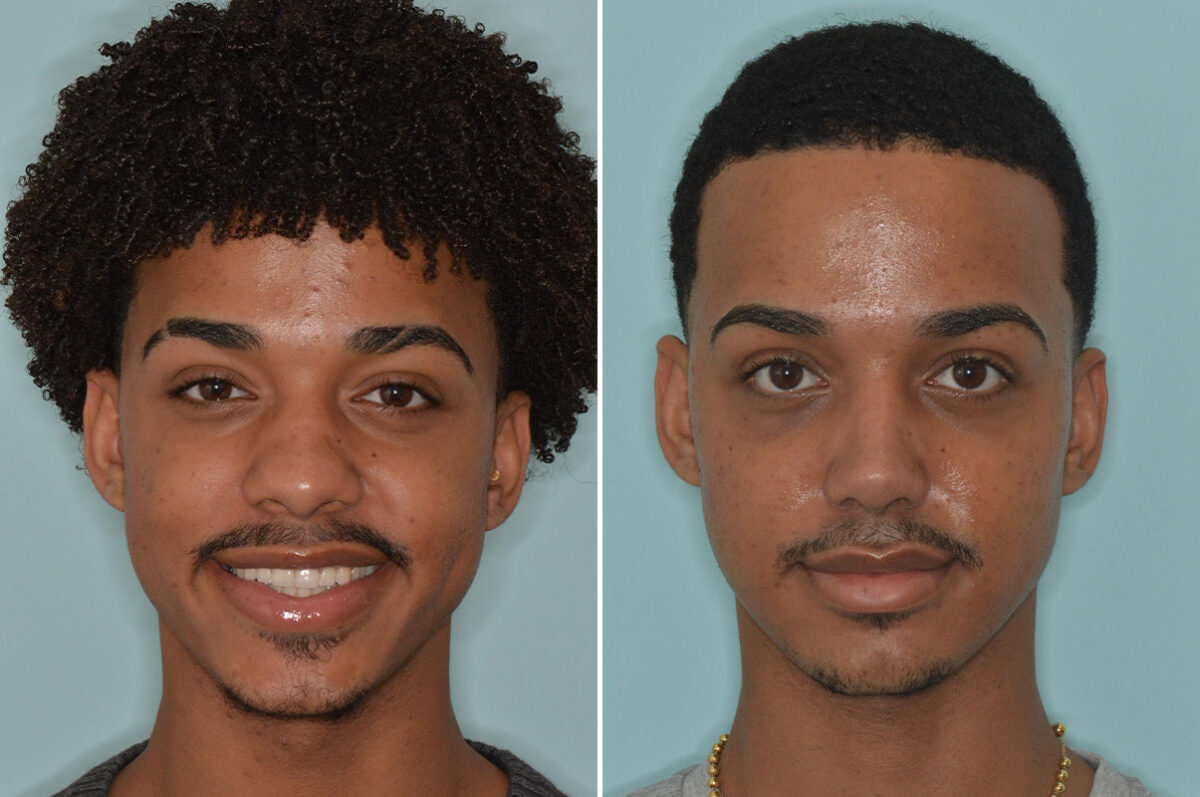 Ethnic Rhinoplasty Before and After Photos in Miami, FL, Patient 9057