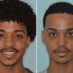 Ethnic Rhinoplasty Before and After Photos in Miami, FL, Patient 9057