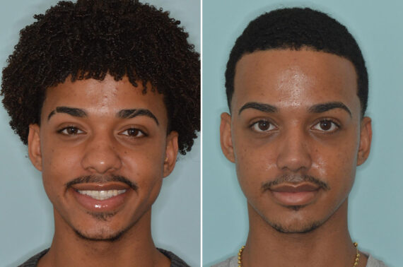 Ethnic Rhinoplasty Before and After Photos in Miami, FL, Patient 9057
