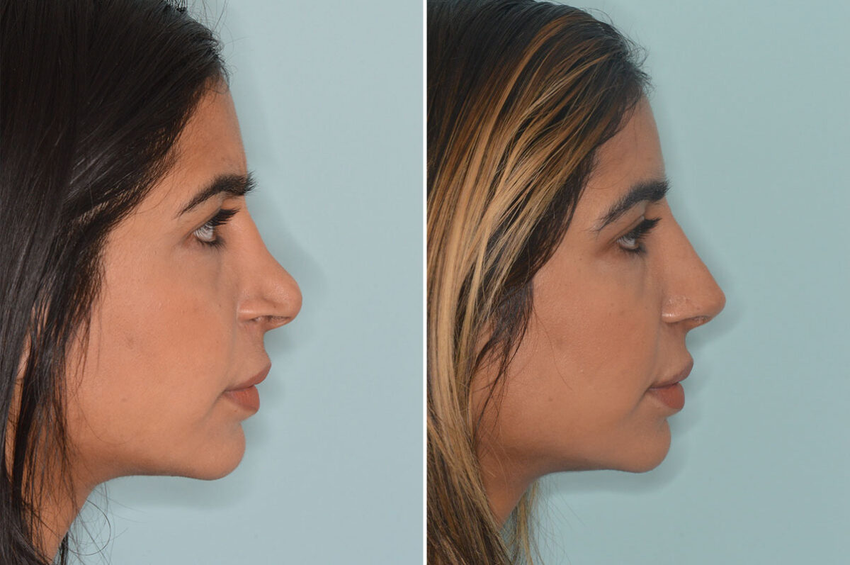 Rhinoplasty Before and After Photos in Miami, FL, Patient 9064