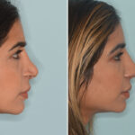Rhinoplasty Before and After Photos in Miami, FL, Patient 9064