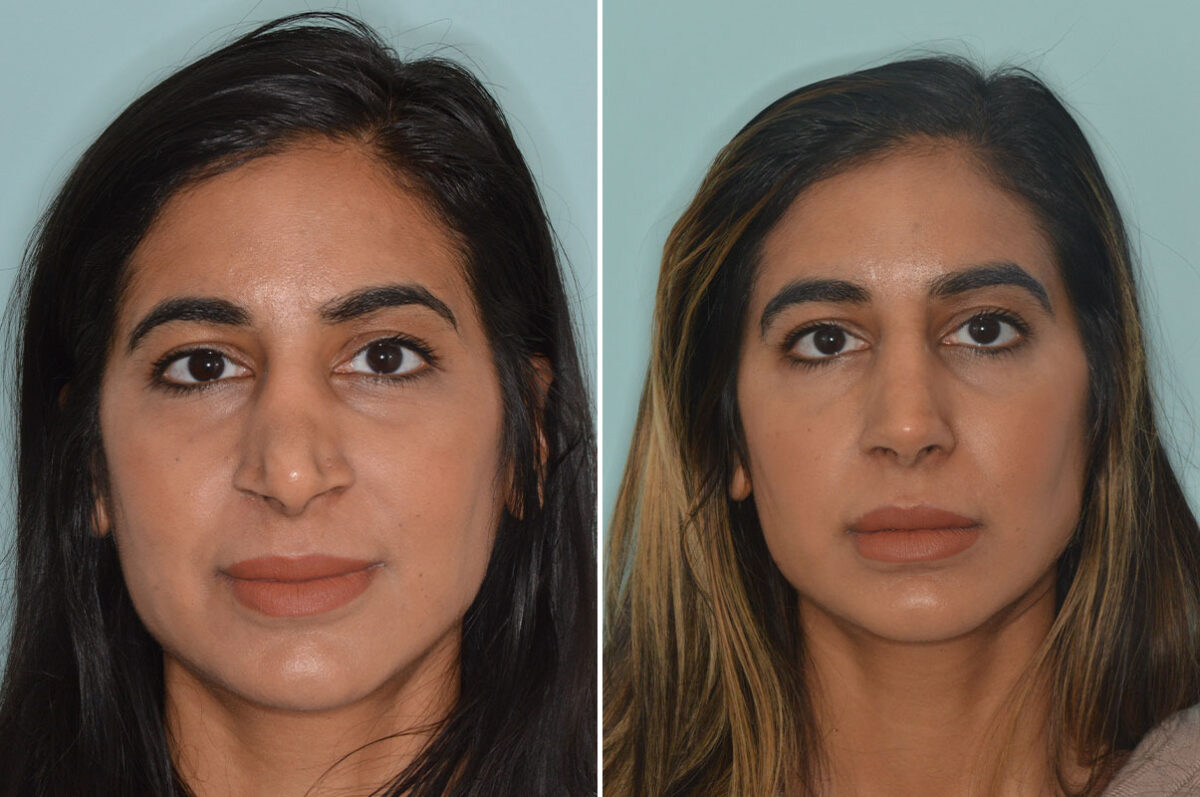 Rhinoplasty Before and After Photos in Miami, FL, Patient 9064