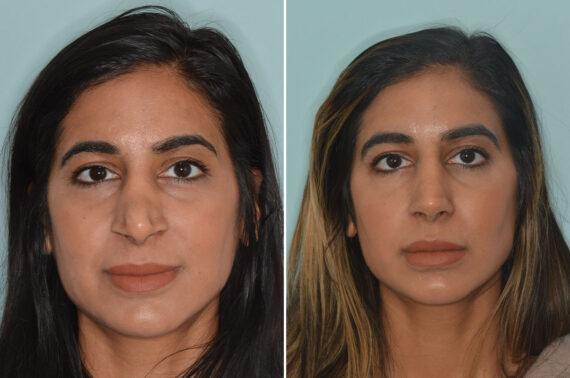 Rhinoplasty Before and After Photos in Miami, FL, Patient 9064