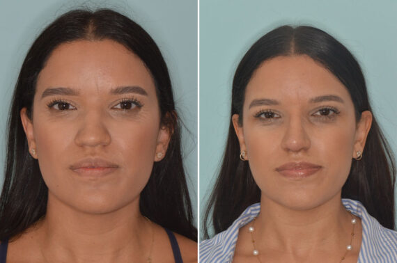 Ethnic Rhinoplasty Before and After Photos in Miami, FL, Patient 9072