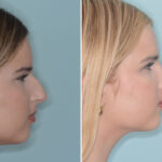 Ethnic Rhinoplasty Before and After Photos in Miami, FL, Patient 9079