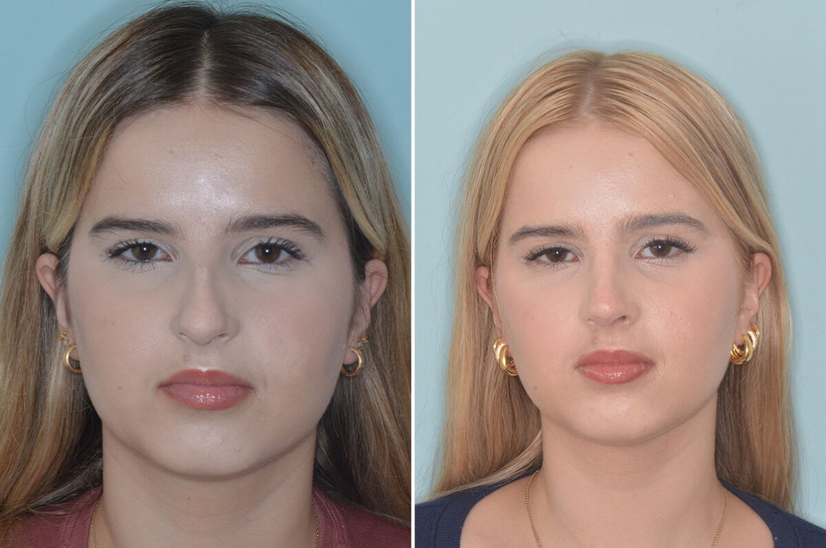Ethnic Rhinoplasty Before and After Photos in Miami, FL, Patient 9079