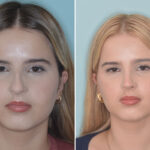 Ethnic Rhinoplasty Before and After Photos in Miami, FL, Patient 9079